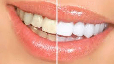 Image for Laser Teeth Whitening