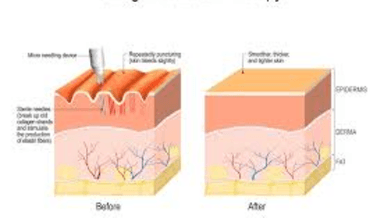 Image for Skin Tightening with Collagen Induction Therapy